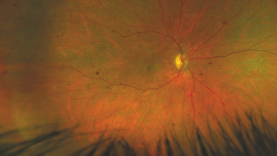 An image from an Optos UWF showing diabetic retinopathy 