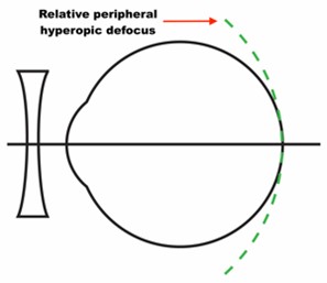 Figure 1 Schematic to demonstrate relative peripheral hyperopic defocus imposed with single vision correction