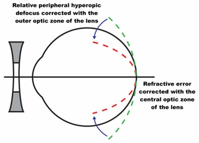 Figure 2 Schematic to demonstrate the concept of correcting relative peripheral hyperopic defocus with an optical myopia management intervention