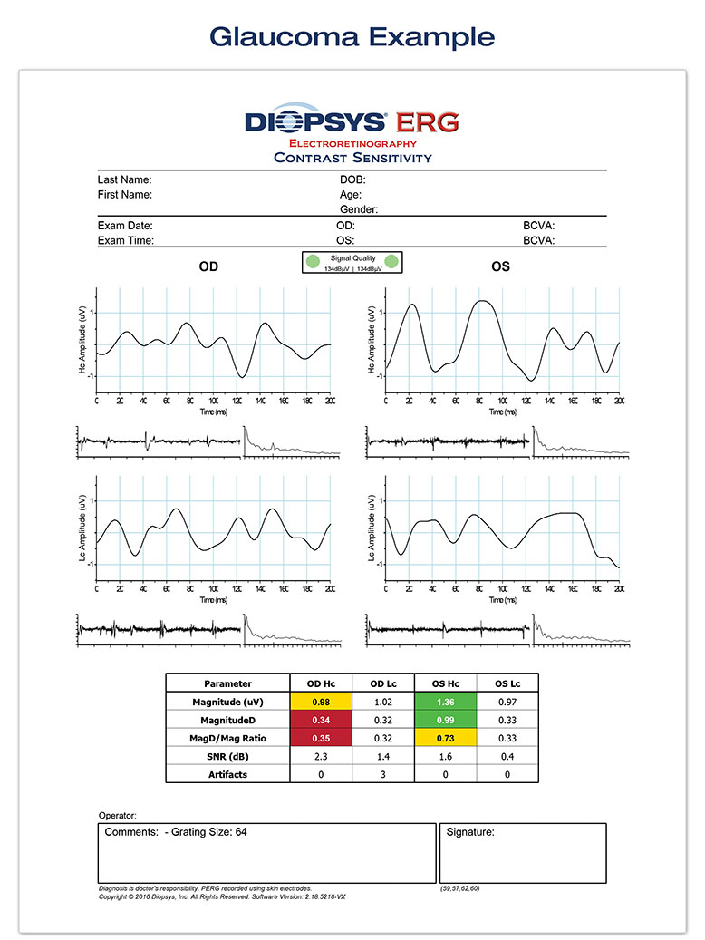 Diopsys glaucoma report