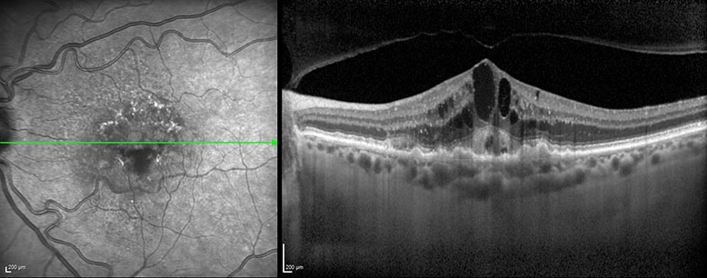 OCT image of neovascular age-related macular degeneration