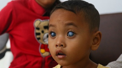 A child with cataracts in Cambodia