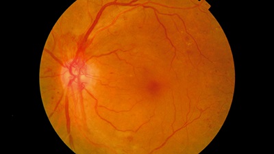 Lucentis shows effectiveness in diabetic retinopathy