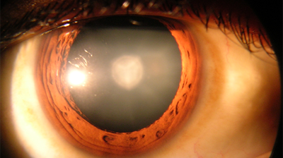 14 lose sight after cataract operation