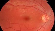 LCA gene therapy unable to stop longterm sight loss
