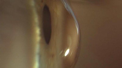 Keratoconic cornea