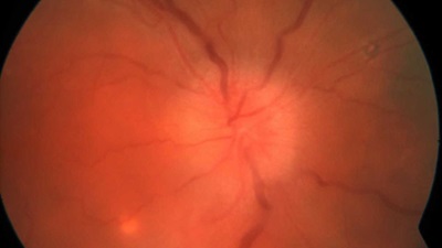 Image of the retina