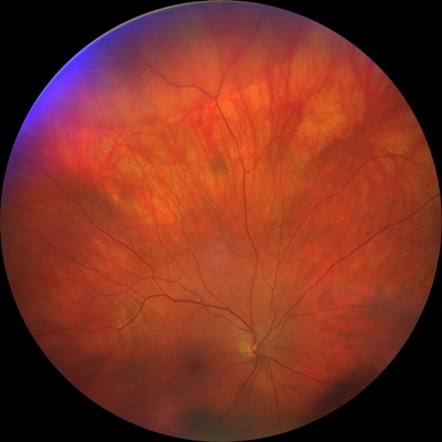 LB’s retinal detachment 
