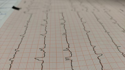 heart monitor graphs 