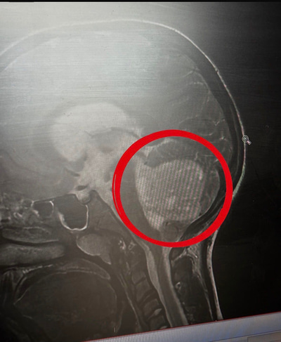 A black and white image from a scan of a skull a large red circle indicates a tumour