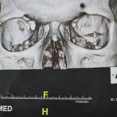 A scan of a skull displaying a bullet fragment in the upper area of the eye socket