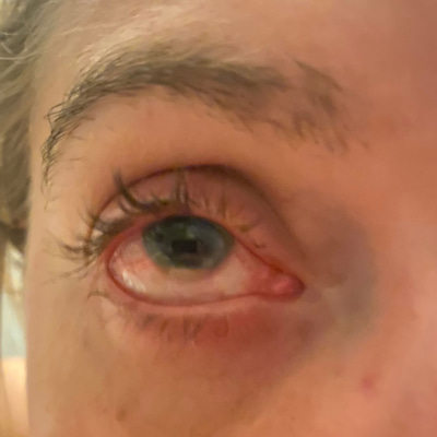 Ellie Irwin’s eye up close with uveitis