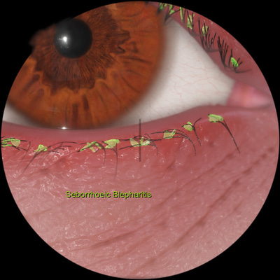 eyesi slit lamp pathological findings