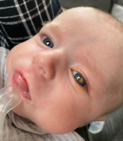 A close up of a small baby looking towards the camera. The pupil of one eye is a reflective glow, suggesting leukocoria. The skin around the eye is also a little discoloured. 