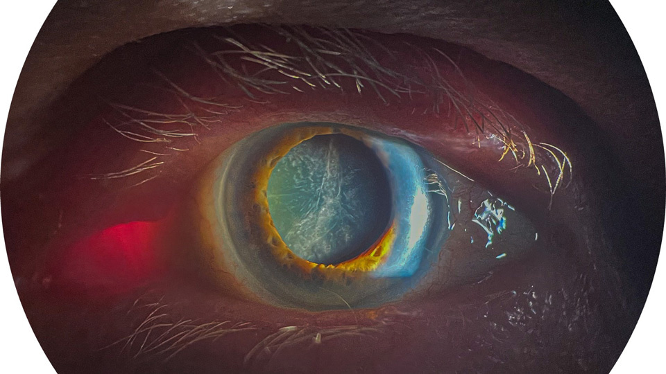 Anterior segment images captured by Hamza Mussa