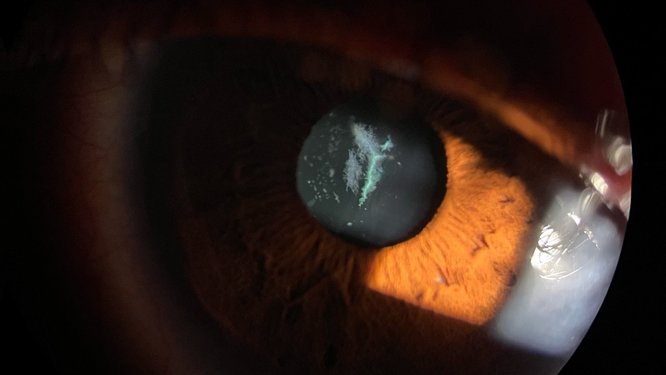 Anterior segment images captured by Hamza Mussa