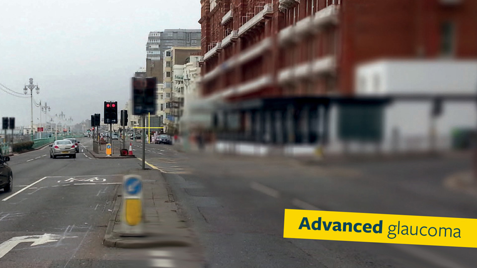 A road in a coastal town, with a car waiting at traffic lights. Cars which were blurry in the moderate glaucoma image have disappeared in this image, indicating advanced glaucoma vision loss