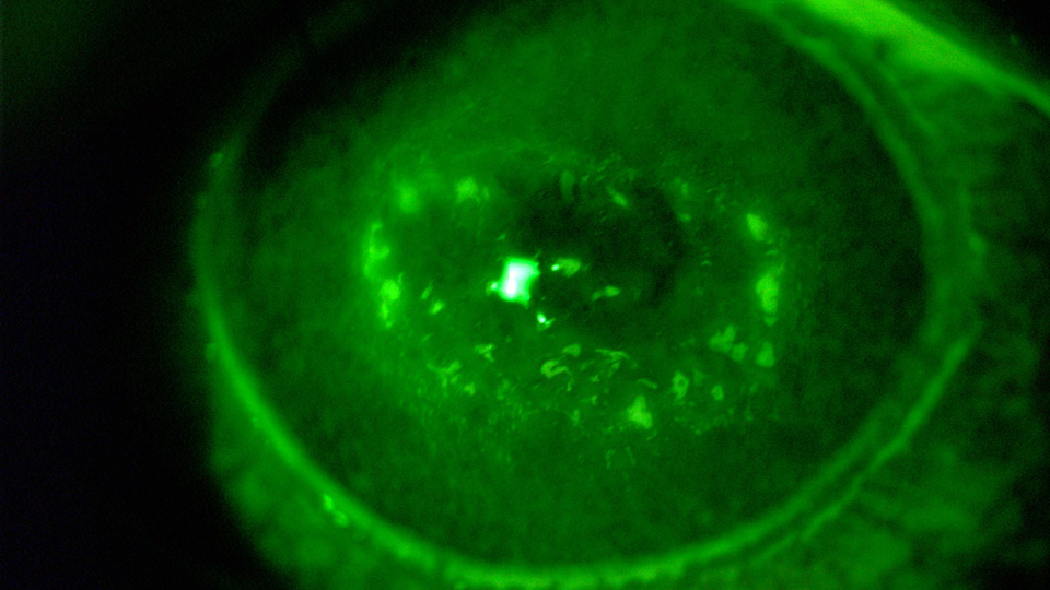 Corneal lesions
