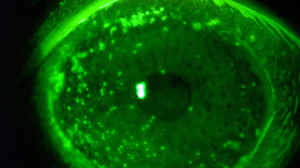 Corneal lesions