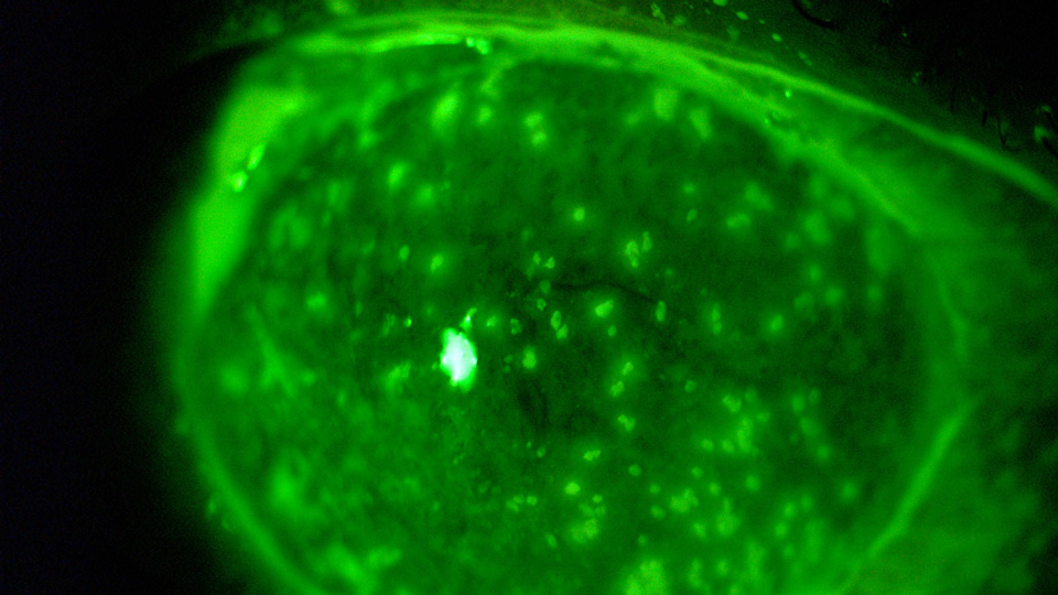 Corneal lesions