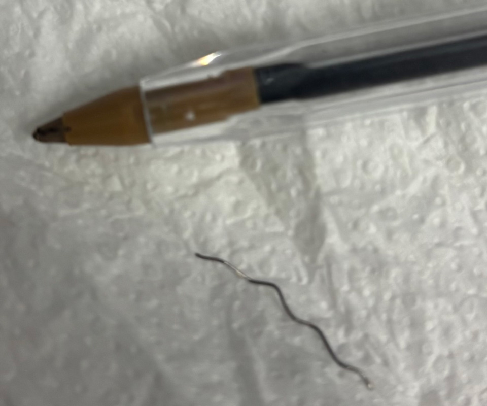 A piece of metal that was removed from Andrew Robertson’s eye – with a pen to show the scale of the wire bristle