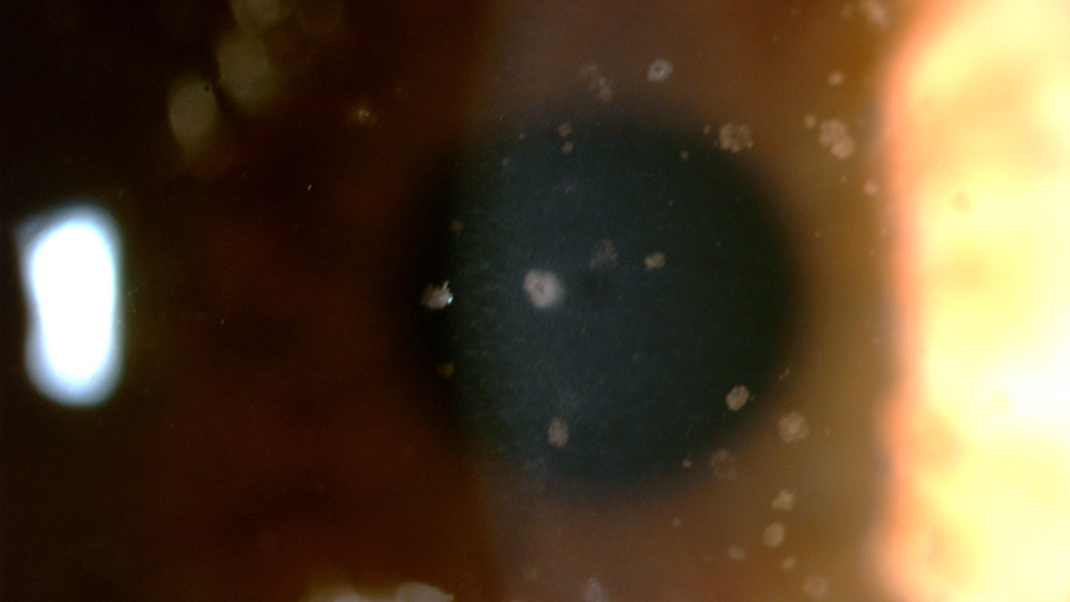 Jemma Iacono’s right eye following an infection with Vittaforma corneaea, a microsporidia species