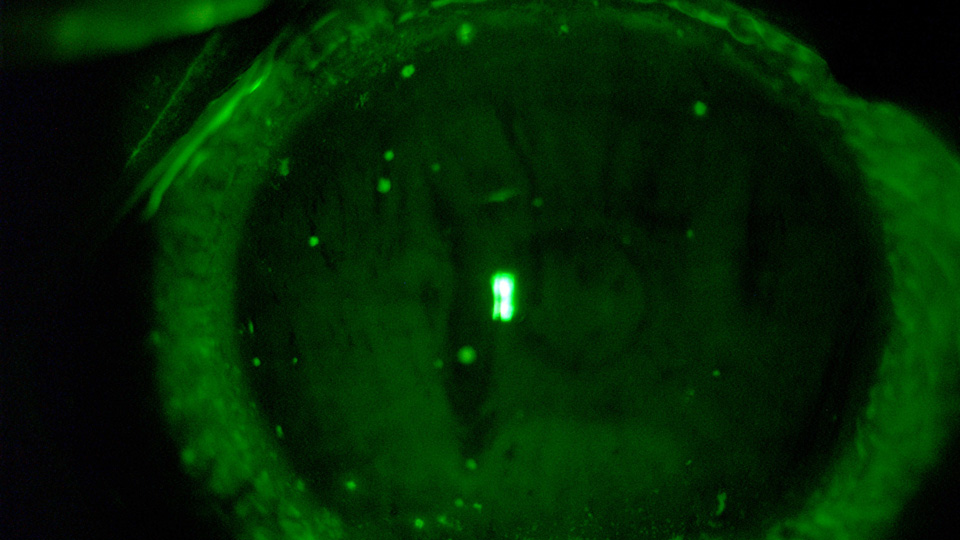 Jemma Iacono’s right eye following an infection with Vittaforma corneaea, a microsporidia species