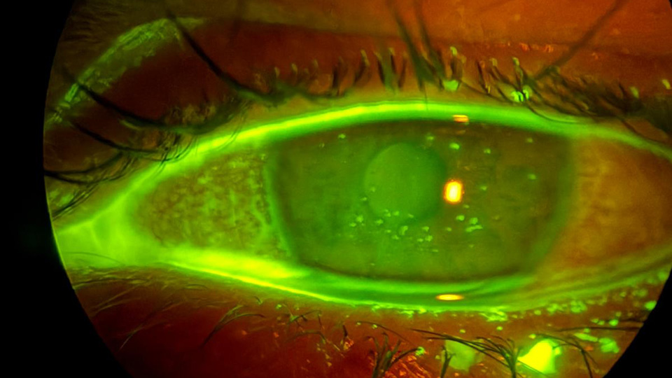 Samuel Wright’s left eye following an MKC infection