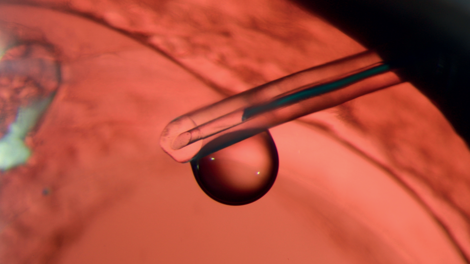 An image taken with a slit lamp of a bubble balancing on the end of a tube. The background is a deep pink globe of an eye