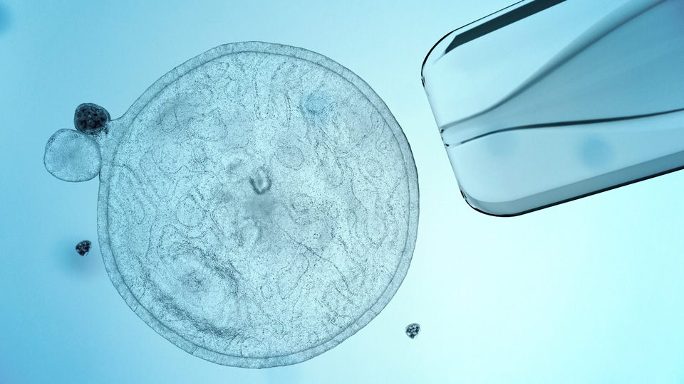 Moorfields Eye Hospital trials new stem cell treatment for ﻿aniridia-related keratopathy