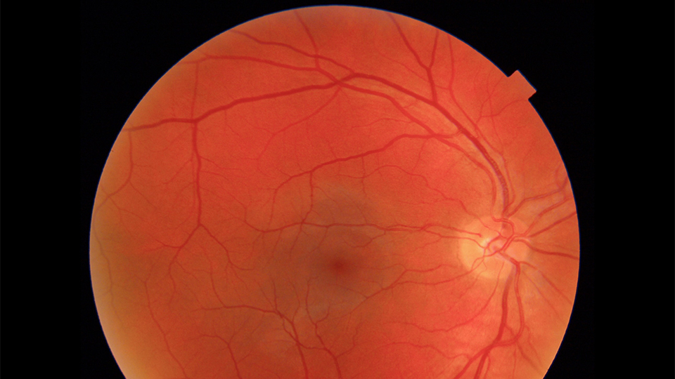 Cascader  retinal