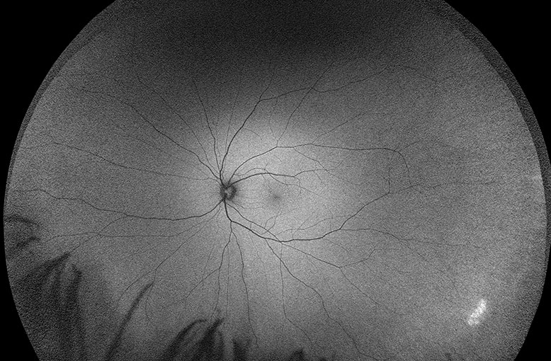 OCT image