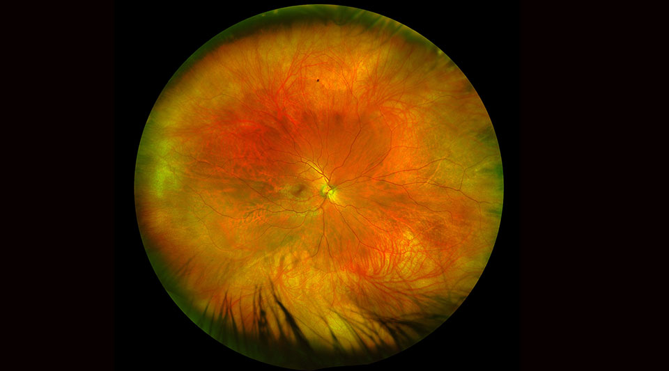 Image of the back of the eye