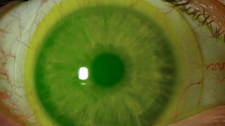 miniscleralcontactlenses