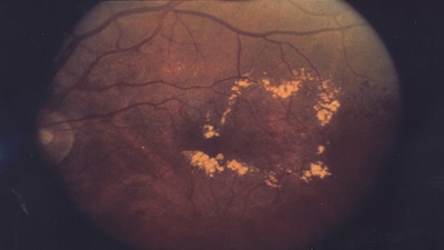 Glaucoma shown in back of the eye image