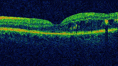 OCT scan of diabetic macular oedema