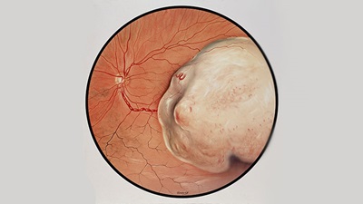 Retinal tumour
