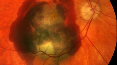 Scientists identify new genetic risk factors for AMD