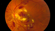 diabetic retinopathy image