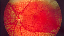 Optom trial to scan cornea for diabetic nerve damage