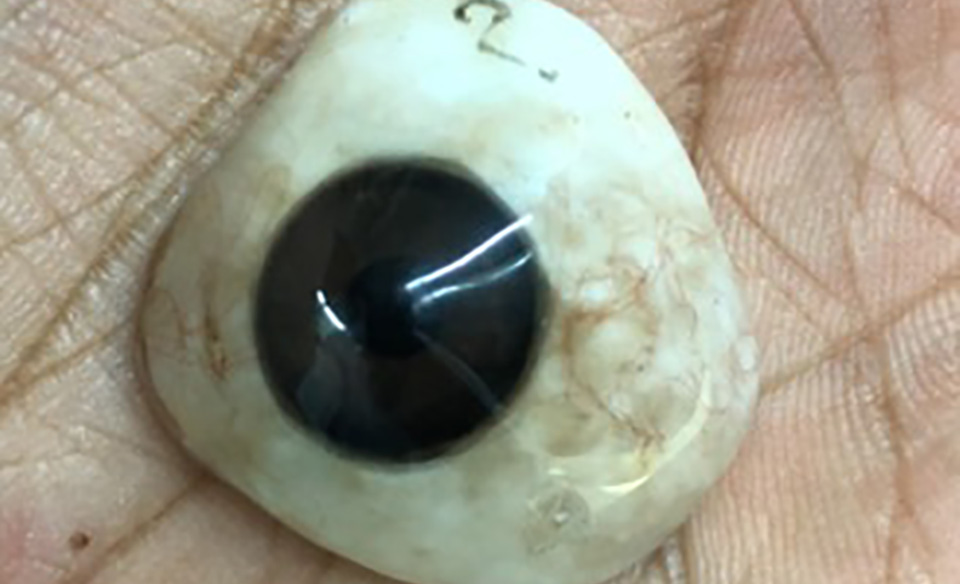 Prosthetic contact lens