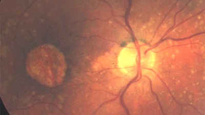 Retina image