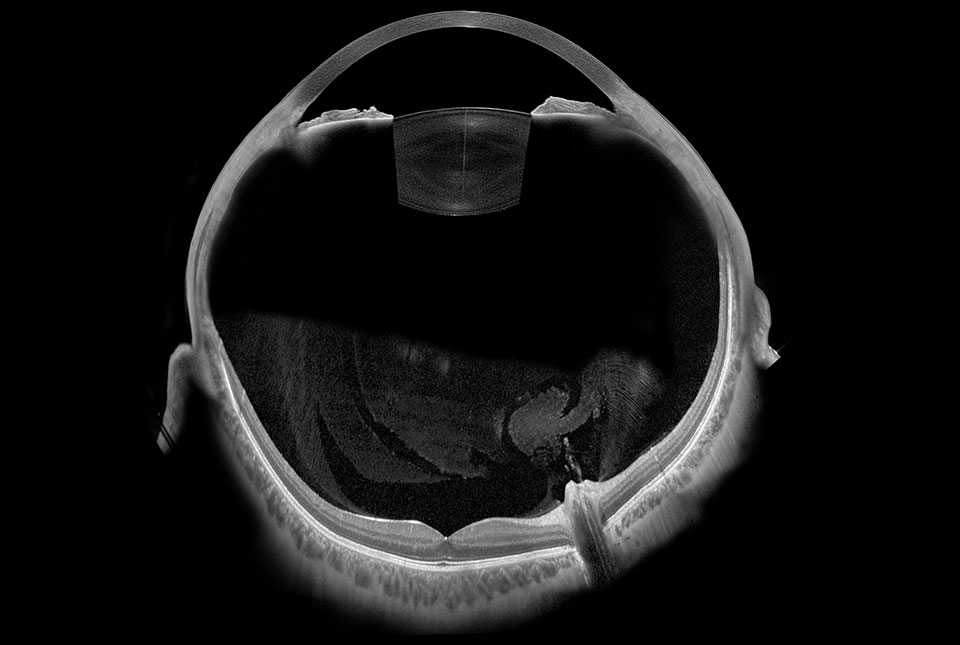Heidelberg 360 eye with vitreous