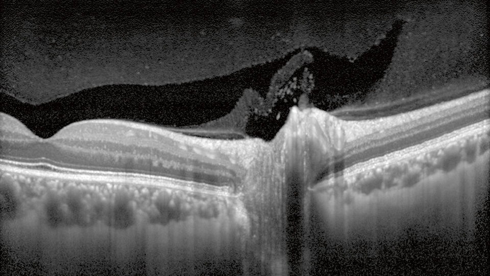 OCT scan