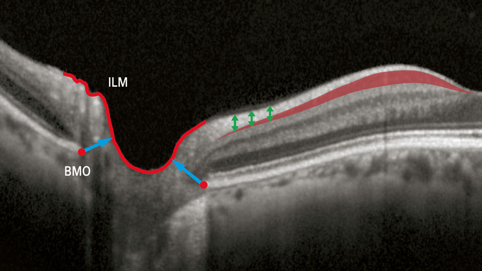 glaucoma structures