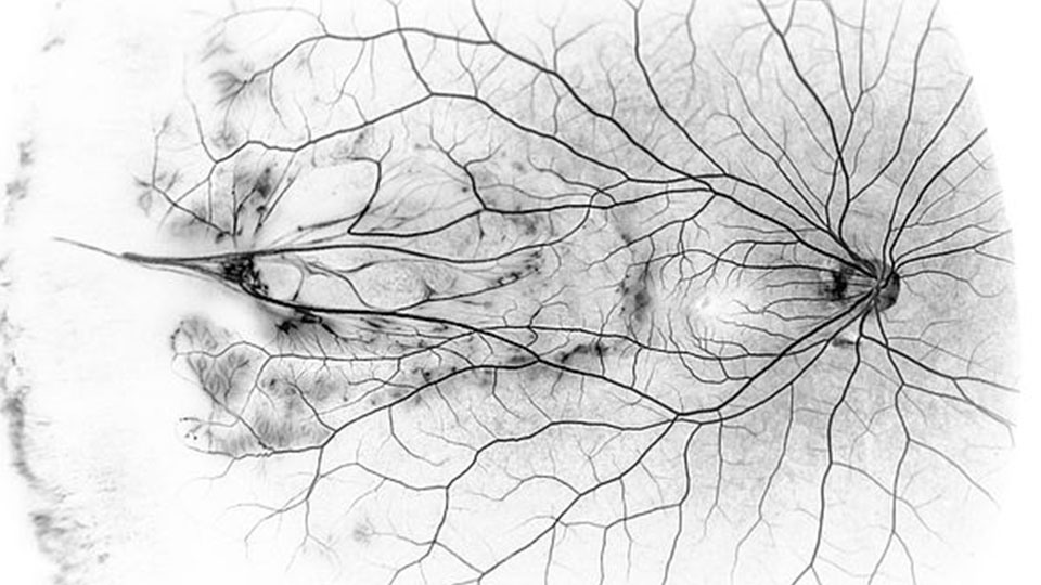 Ocular photography