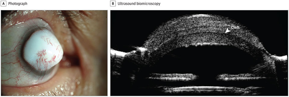 Lesion in eye