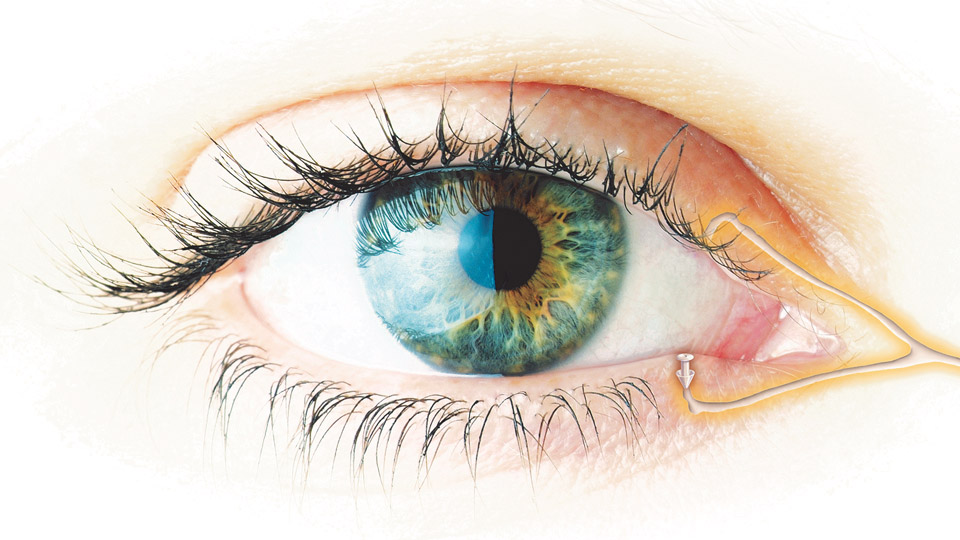 Positive Impact punctal plugs