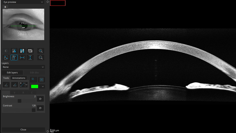Full range Anterior Chamber