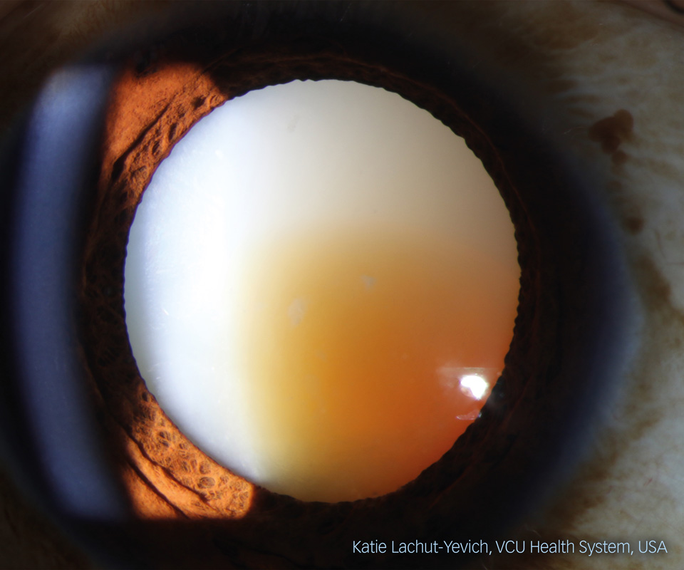This macro image displays an eye with a dense white lens, tinged with brown in the bottom right third